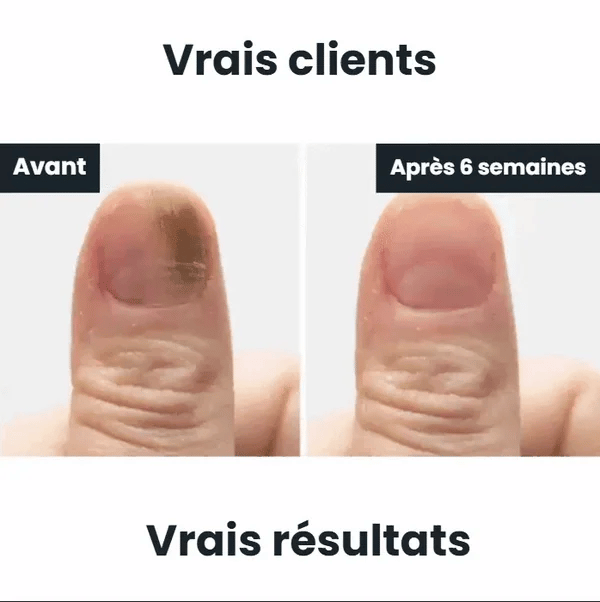 Onyra™Stylo antifongique de precision