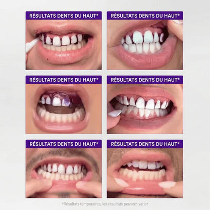 Smilora™, Retrouvez un sourire éclatant en 30 minutes — sans cabinet dentaire